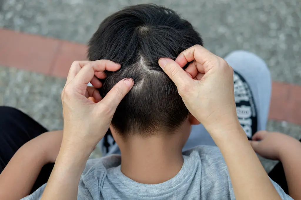 How Contagious Is Head Lice? LiceDoctors